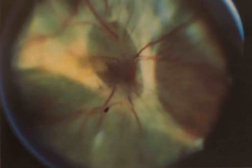 pvr proliferative vitreoretinopathy