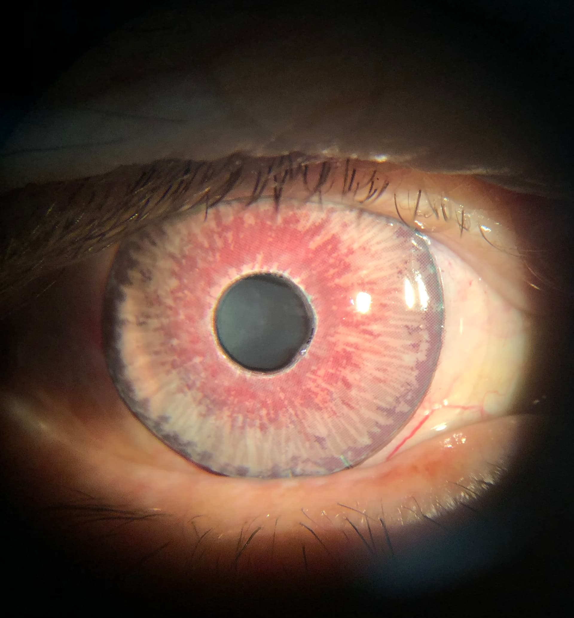 Photo Competition Post Traumatic Mydriasis