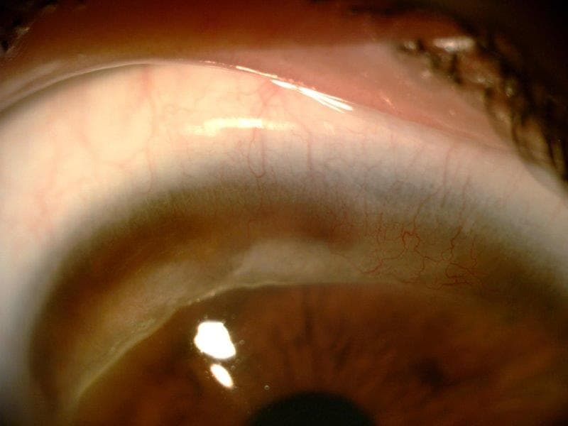 A rare but profound cause of corneal thinning-terrien-case-figure-2.jpg