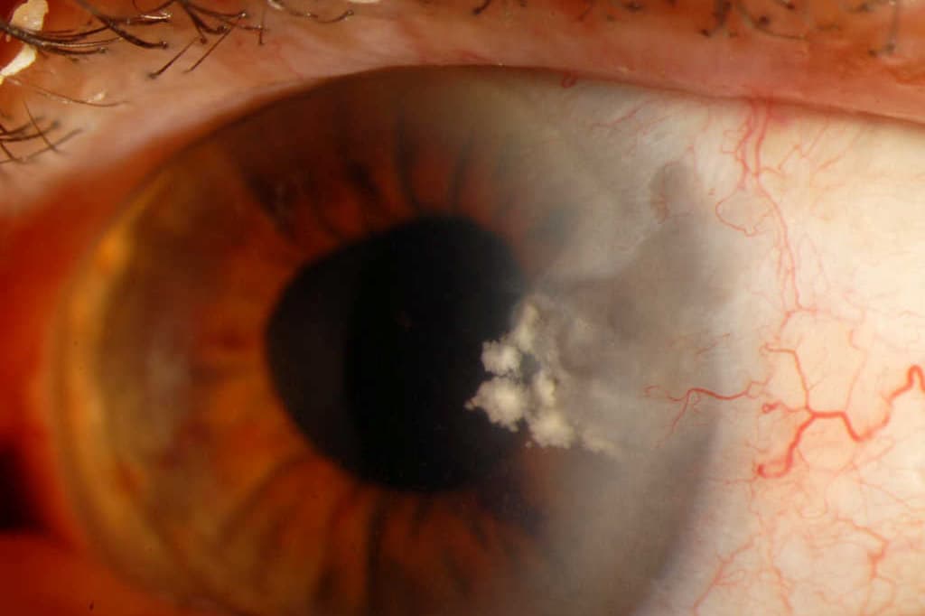 A rare case of Mycobacterium chelonae keratitis-mycobacterium-case-fig-2.jpg