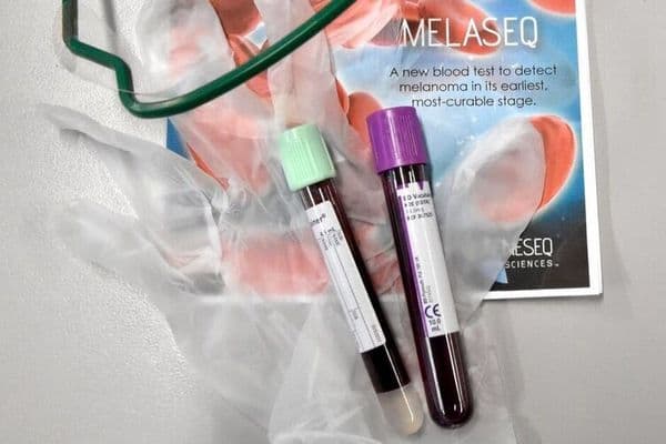 Melanoma blood test a step closer