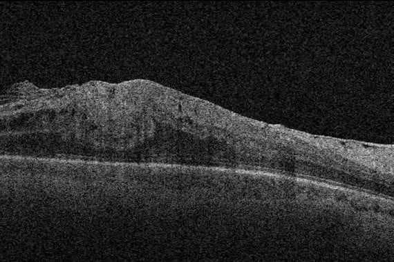 Case study: epiretinal membranes and the Govetto classification (1)
