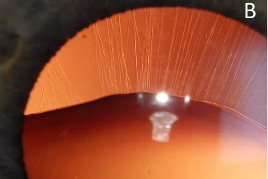 An accommodating view of Zinn’s zonule (1)