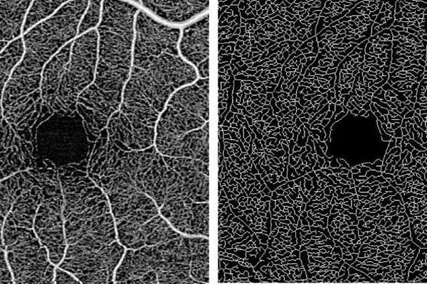 Retinal capillary changes associated with dementia