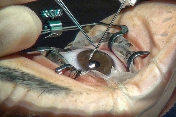 Long-term efficacy and safety of MIGS in glaucoma management (1)