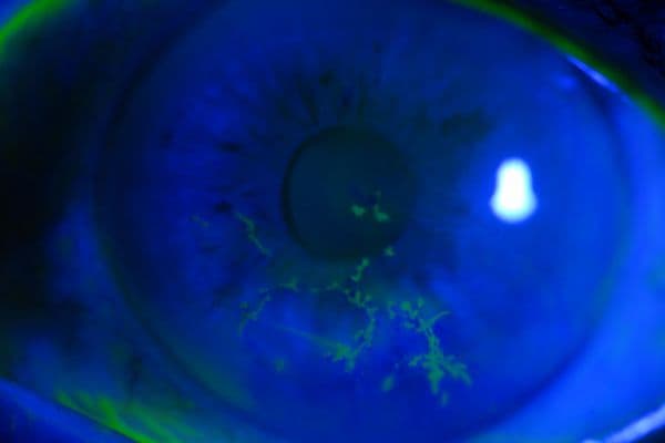 HZO-related disease post-cataract