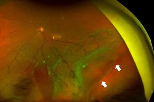 Atopic dermatitis and retinal detachment (1)