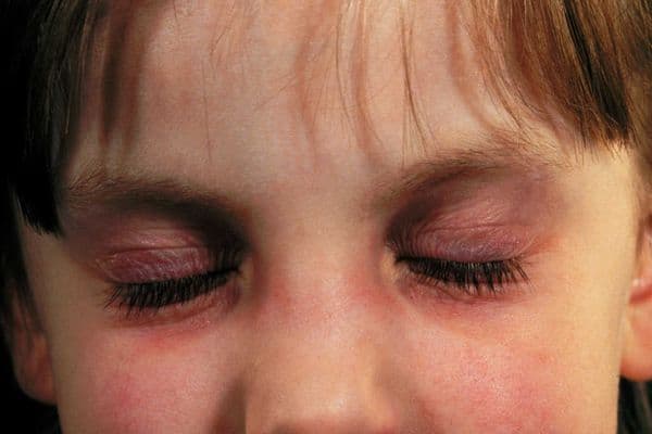 Ezcema treatment exacerbates DED