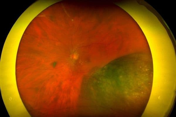 Retinal research and uveal melanoma