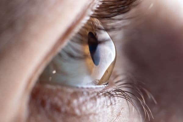 Assessing extent of keratoconus in Gisborne