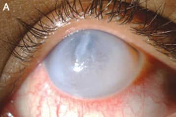 Keratoconus and Pasifika in Aotearoa