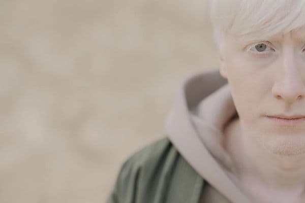 Improving VA for patients with albinism