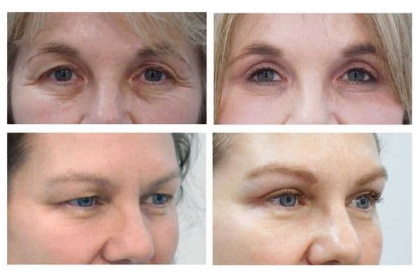 Blepharoplasty goes viral