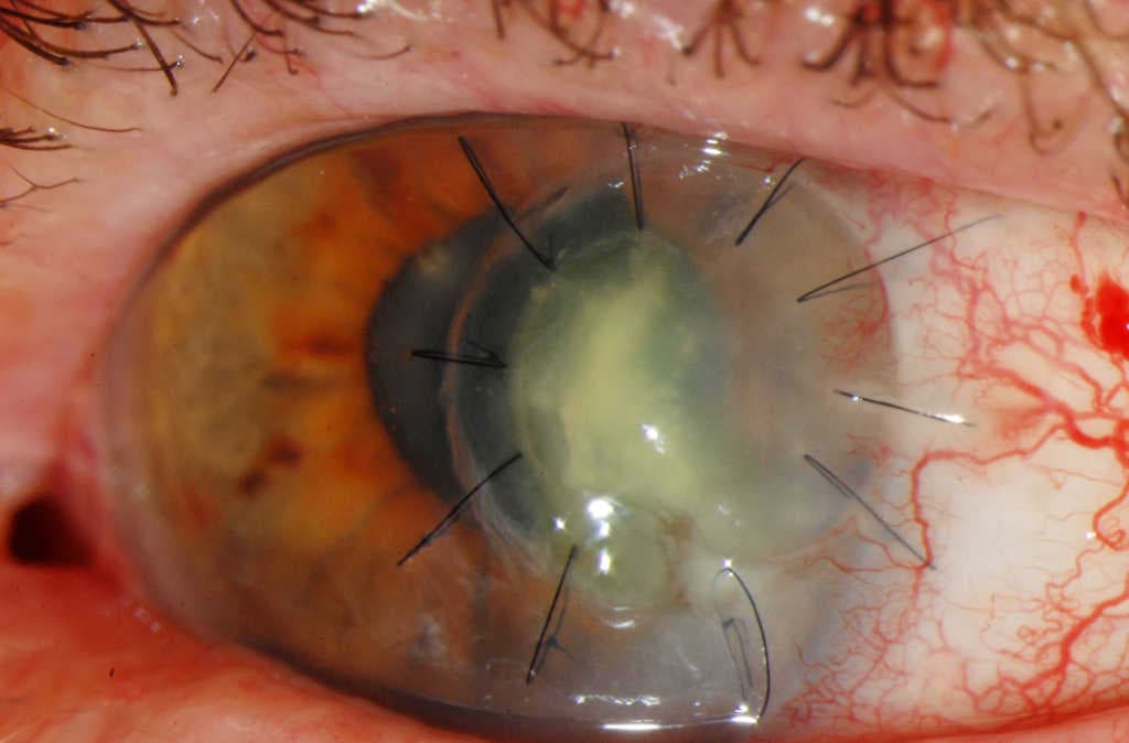 A rare case of Mycobacterium chelonae keratitis-mycobacterium-case-fig-4a.jpg