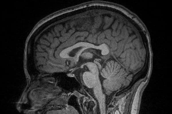 CVI study yields assessment tool