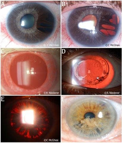 The iris in health and disease, part II: Iris transillumination defects and rubeosis iridis-fig-1-small.jpg