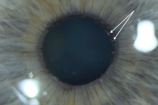 Oh no, the drain is blocked! PXF and glaucoma (1)