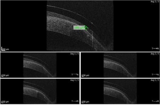 New post-surgery lens for irregular-cornea patients-fig-2-dc-raster.jpg