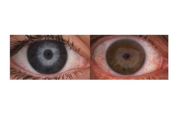 New study to evaluate the best method of assessing ocular inflammation in DED