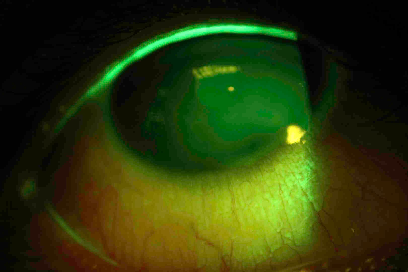Bandage Contact Lenses-fig-5.jpg