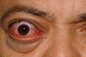 First TED drug?