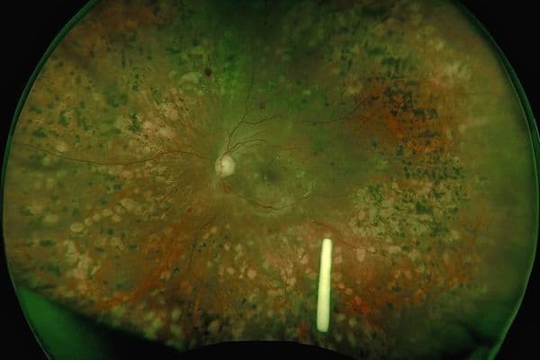 Ozurdex ‘real-life’ results - effective for DME