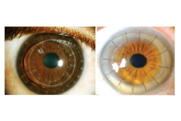 Long-term trends in keratoplasty in Aotearoa