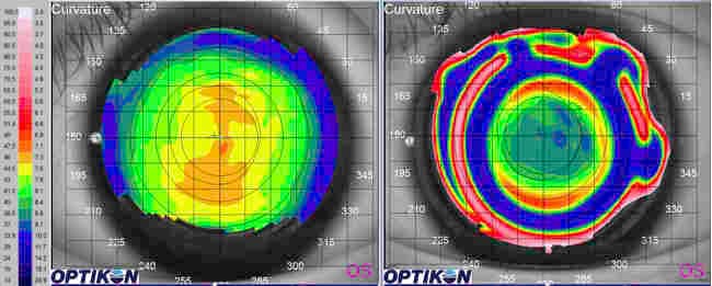 Non-ortho-k CL options for myopia control-fig-5.jpg