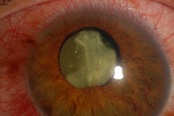 Nutrition and diabetic retinopathy: a path to sight-saving changes