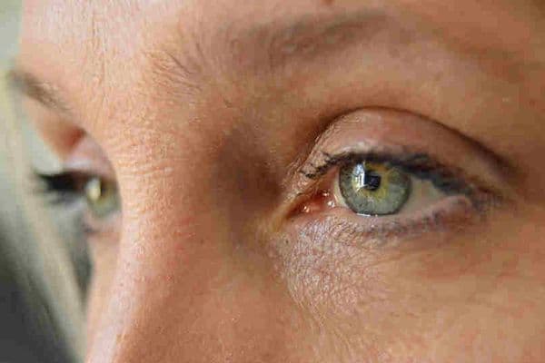 New floppy eye treatment