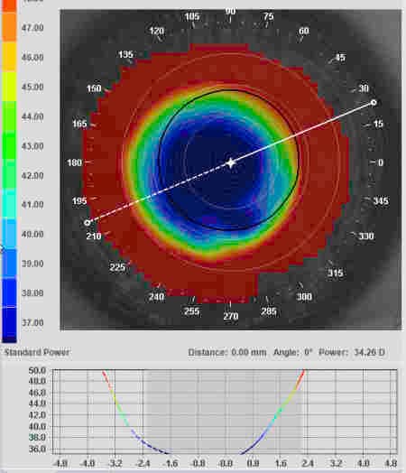 Non-ortho-k CL options for myopia control-fig-6-artmost-topography.jpg