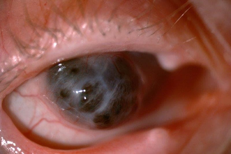 Update on herpes zoster ophthalmicus-fig-3.jpg