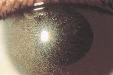 FDA approves drop for ocular cystinosis