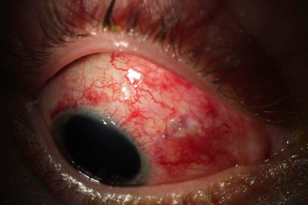 Ortho-k: tackling the epidemic
