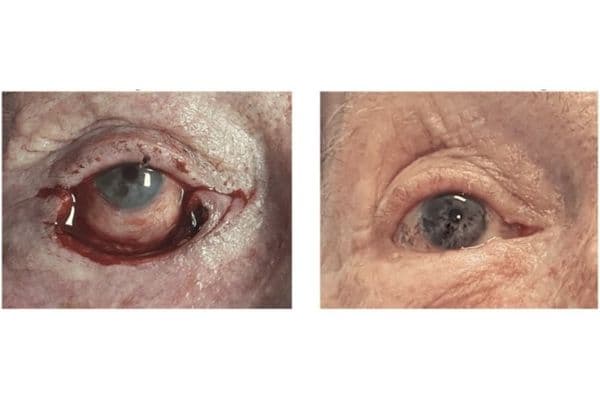 A novel reconstructive surgery for lower eyelid defects