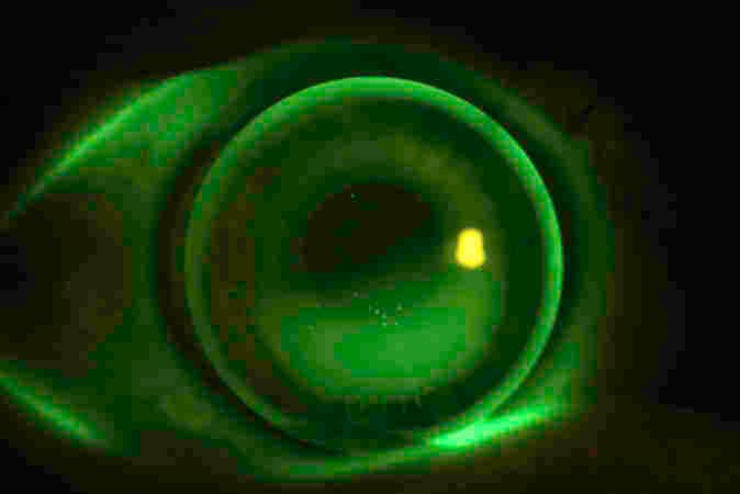 Non-ortho-k CL options for myopia control-fig-7.jpg