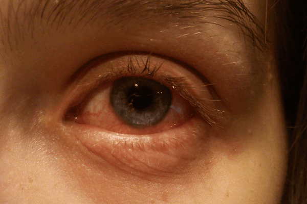 Viral conjunctivitis study seeks patients