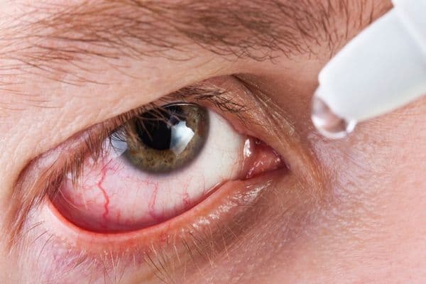 phsmoeow eye drops eye close up