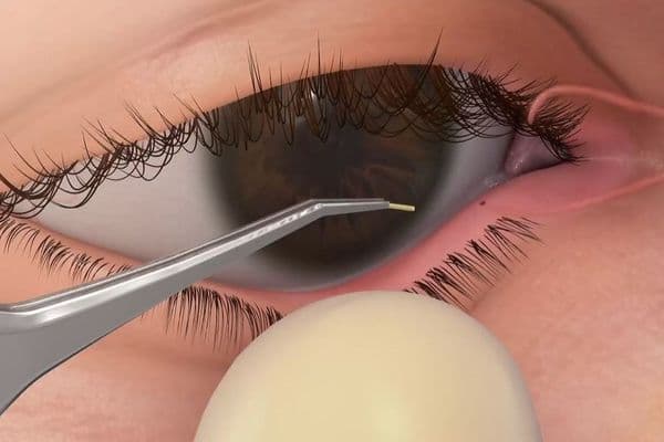 DED drug misses endpoint