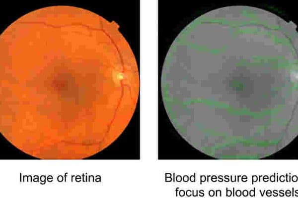 Retina scans and AI detect heart disease