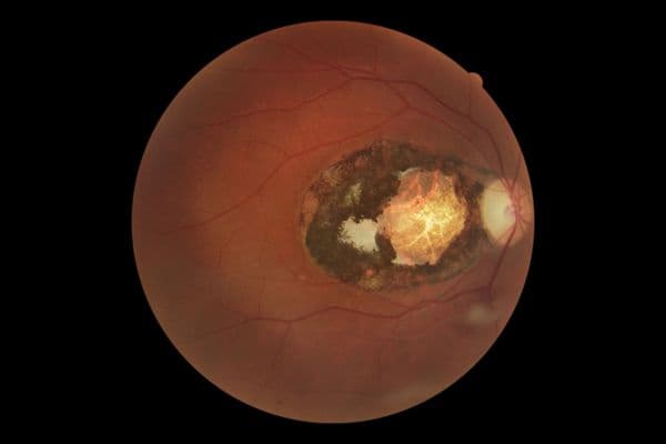 toxoplasmosis
