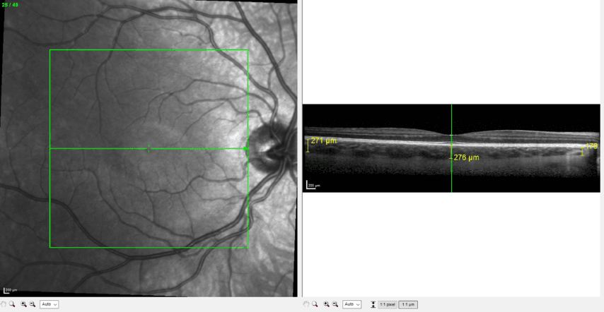 Fig 3 Case One, Choroidal Thickness Pretreatment