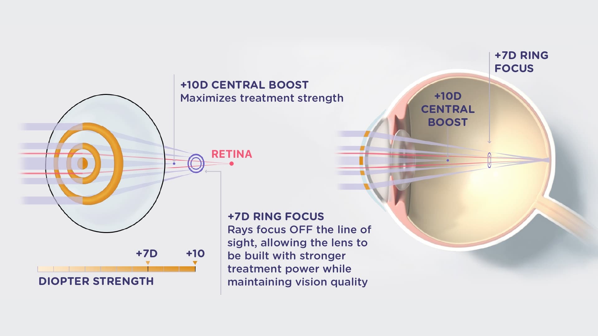 Fig 1 Abiliti 1 Day Ringboost Lens Design