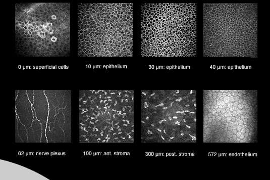 The return of the HRT3 corneal microscope