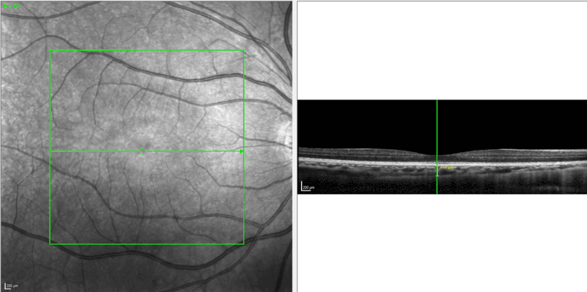 Fig 6 Case Two Pretreatment Choroidal Thickness