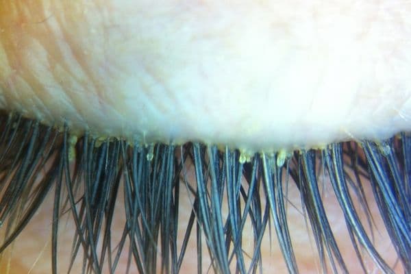 demodex infestation online