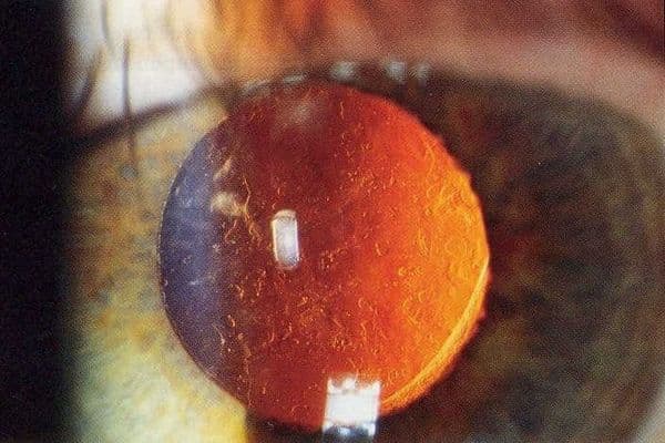 Comment: YAG laser optometry scope change