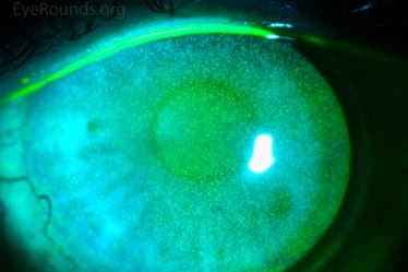 LETTER: Parkinson’s case study - The importance of spotting microtremors (1)
