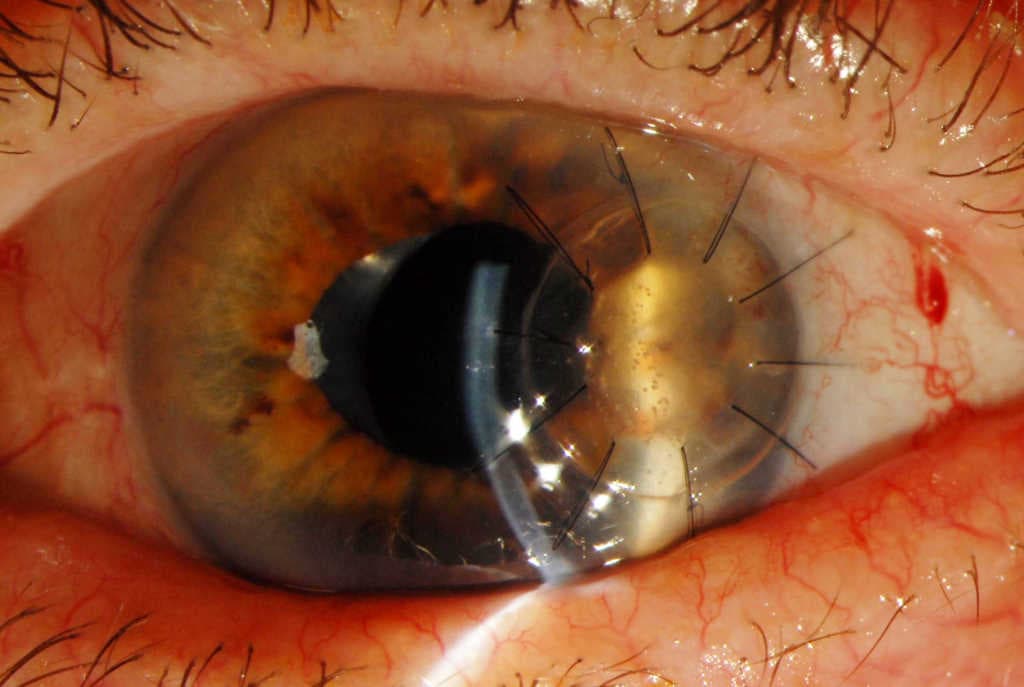 A rare case of Mycobacterium chelonae keratitis-mycobacterium-case-fig-3.jpg