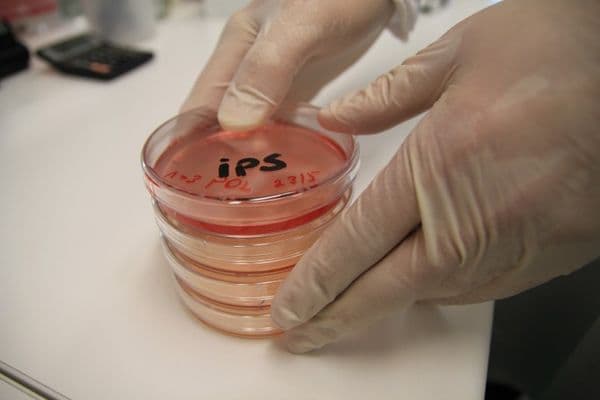 IRD stem cell trial begins